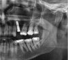 Implantat.jpg